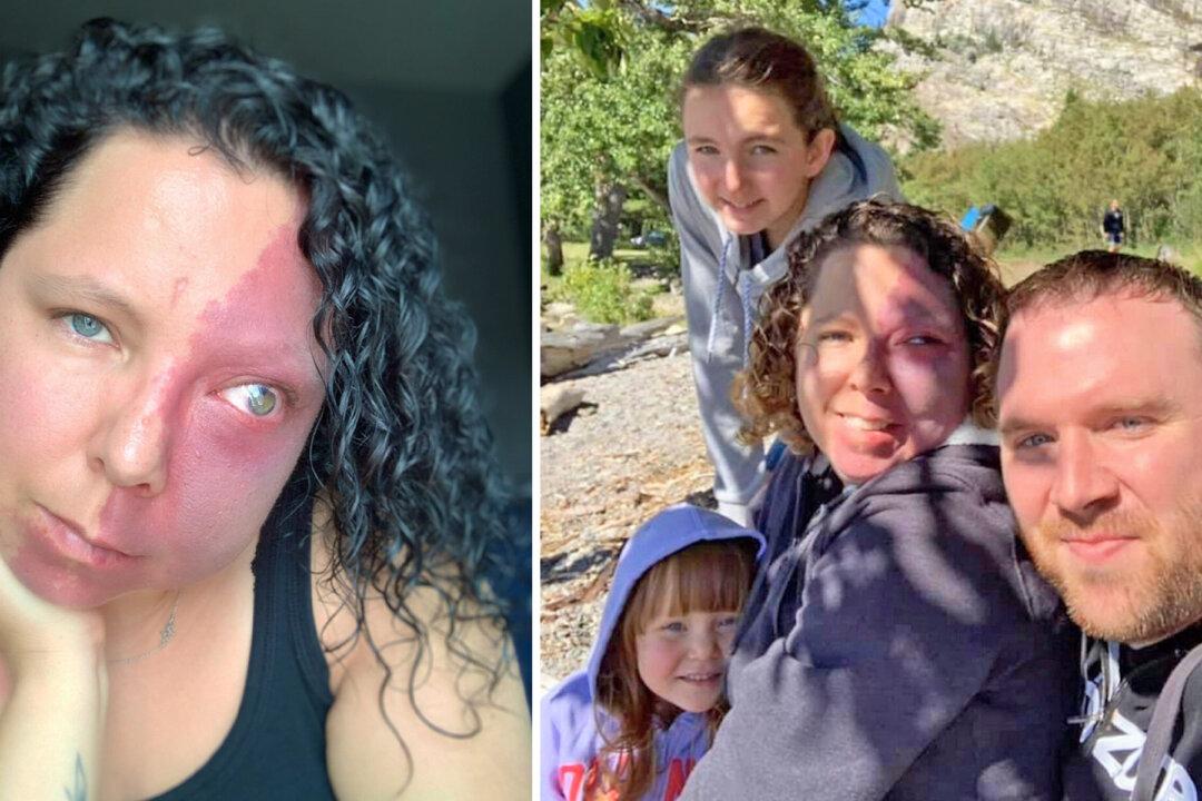 Mom Who Was Bullied for Facial Birthmark Thought She'd Never Find Love, Now Has a Dream Family