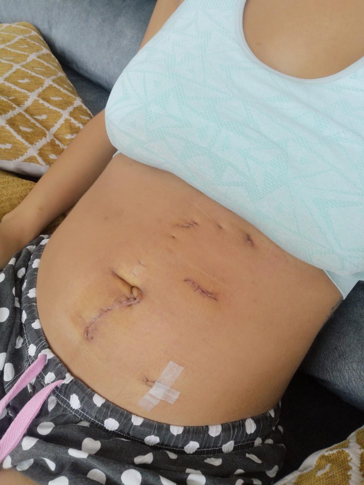 Rachel's scars after kidney surgery. (Caters News)