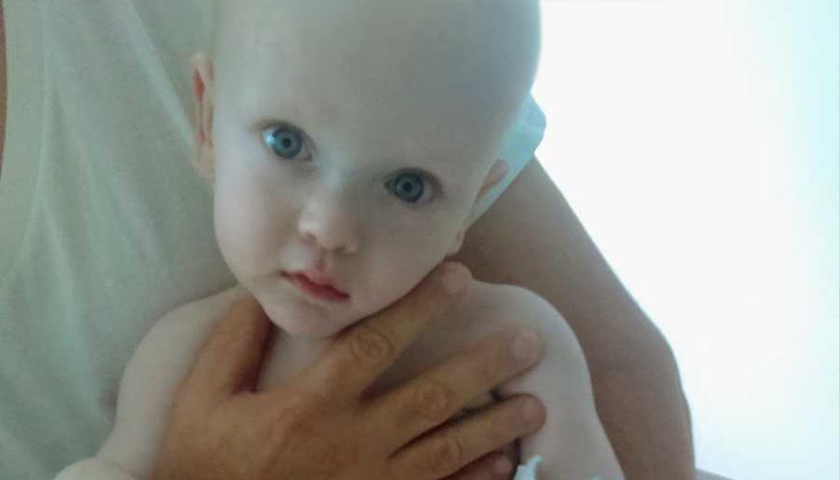 Abused Baby Who ‘Resembled an Alien’ Thrives With Loving Adoptive Family