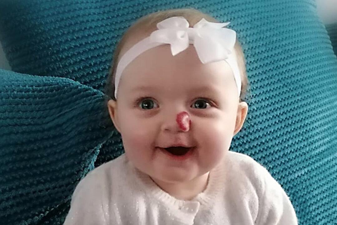 Parents Want Baby’s Strawberry Birthmark Removed After Stranger Calls Her ‘Rudolph’