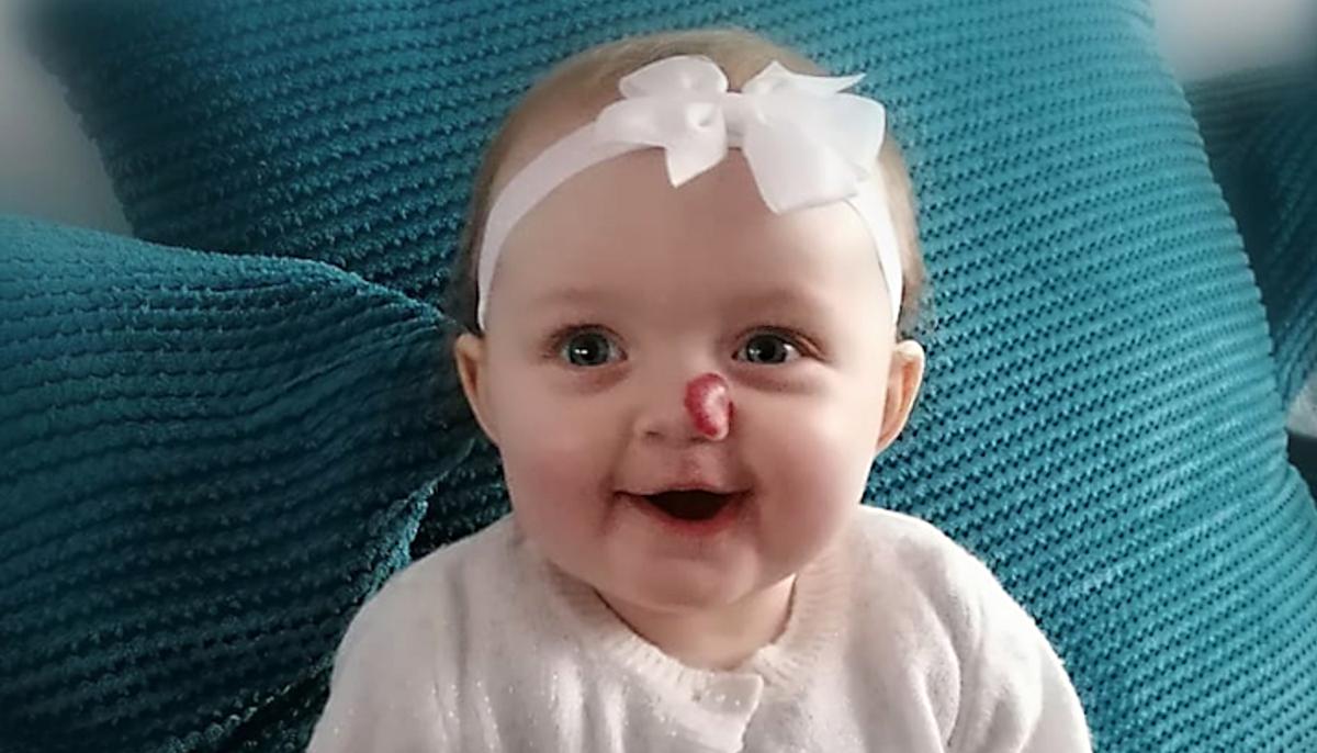 Parents Want Baby’s Strawberry Birthmark Removed After Stranger Calls Her ‘Rudolph’