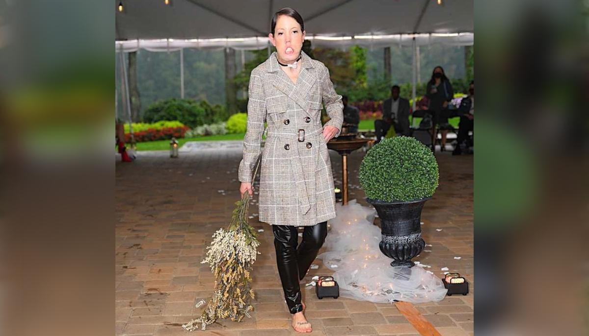 Mom-of-2 With Facial Abnormality That Doesn’t Allow Her to Smile Becomes a Model