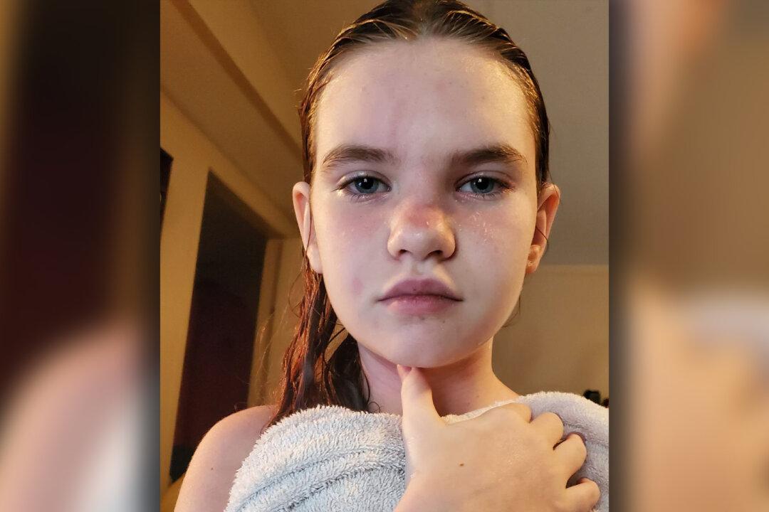 Schoolgirl’s Rare Water Allergy Is So Severe Even Showers Could Be Fatal