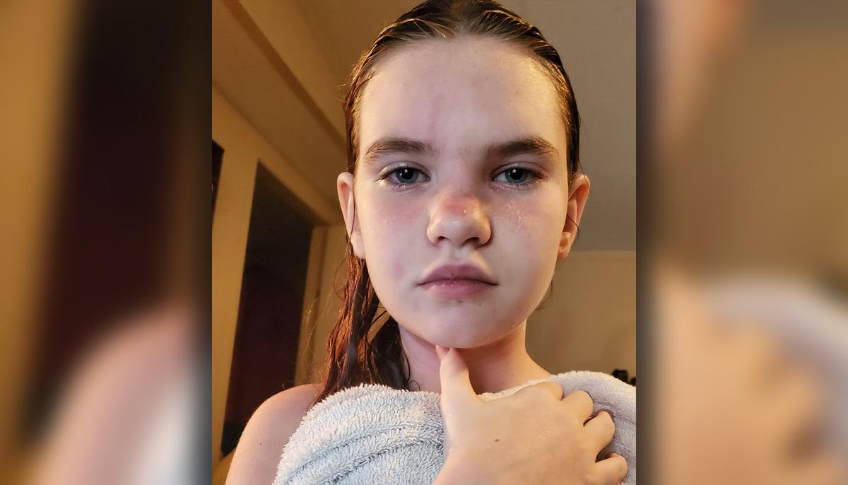 Schoolgirl’s Rare Water Allergy Is So Severe Even Showers Could Be Fatal