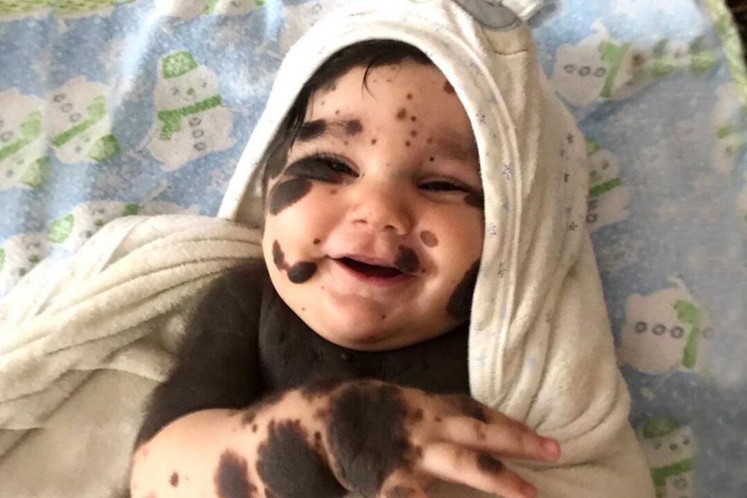 ‘Baby Boy Panda’: Parents Refuse to Give Up Newborn Son With 80 Percent Birthmarks