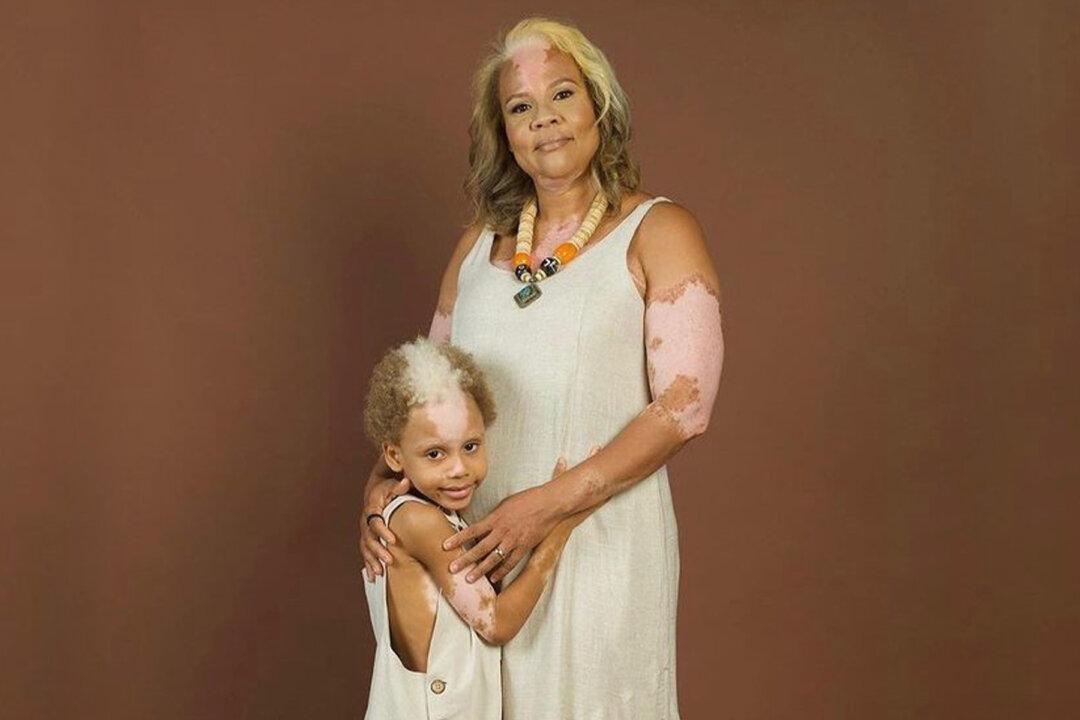 Boy, 7, With Rare Skin Condition Like His Mom Becomes Face of Inclusion in the Fashion Arena