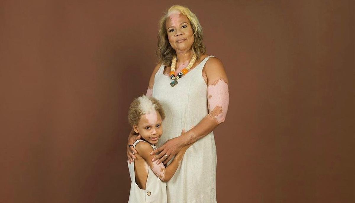 Boy, 7, With Rare Skin Condition Like His Mom Becomes Face of Inclusion in the Fashion Arena