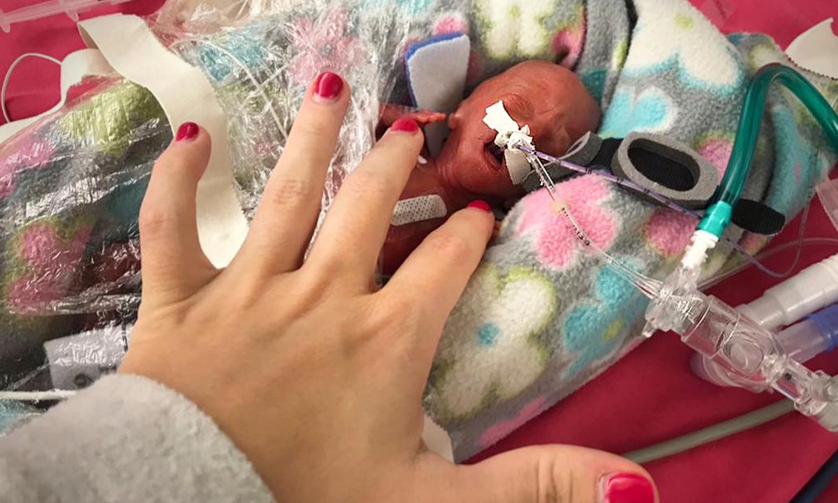 ‘World’s Most Premature Twins’ Celebrate Their 2nd Birthday After Beating the Odds