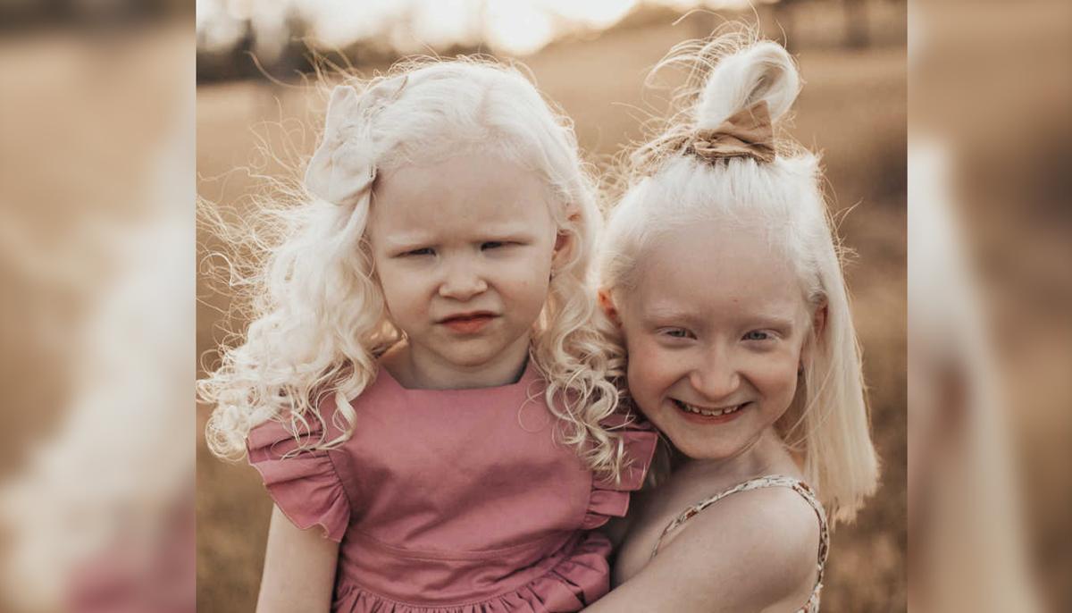 From Initial Fears to Developing a Fighting Spirit, Mom Raises Two Albino Daughters