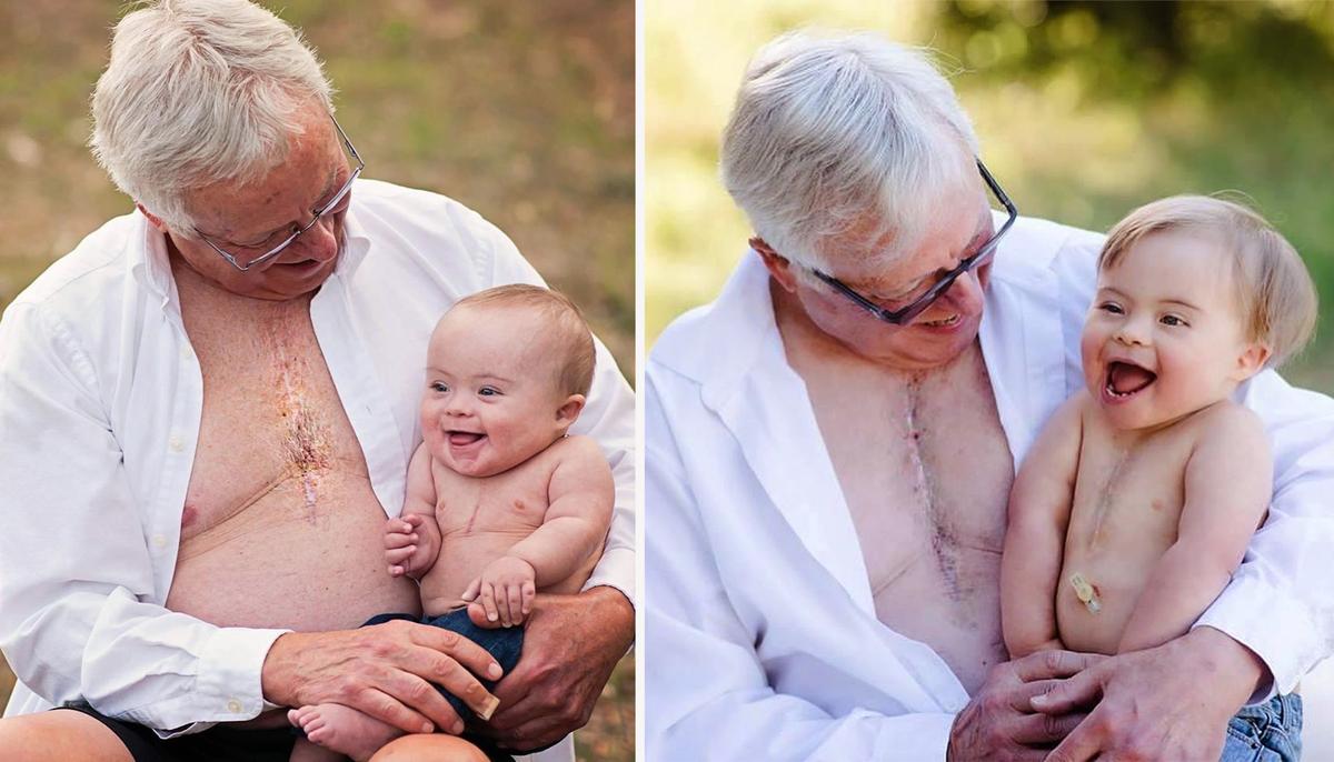 Grandpa and His Grandson With Down Syndrome Share ‘Heartiversary’ and Matching Scars