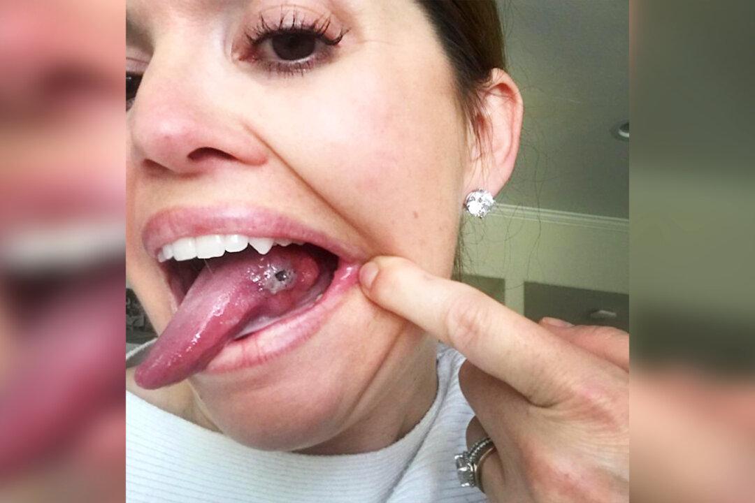 Woman Thought Sore on Her Tongue Was a Bite Mark, Until Doctor Told Her the Bad News