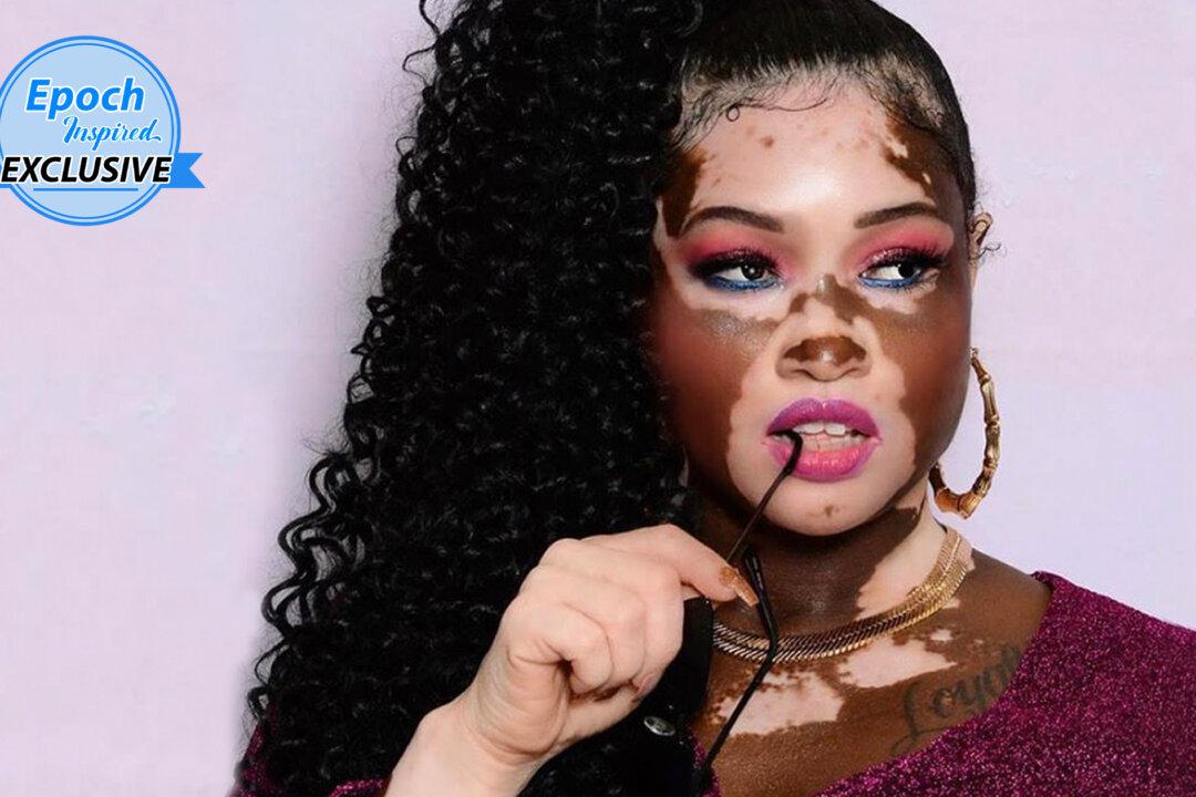 Woman With Vitiligo Was Mocked, but Became a Model, Urges: ‘It Doesn’t Matter What They Think’
