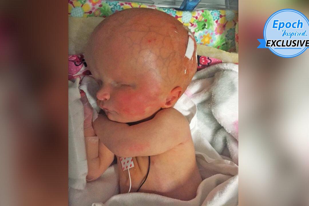 Girl Born With Two-Thirds of Her Brain Missing and No Eyeballs Defies Doctors’ Predictions