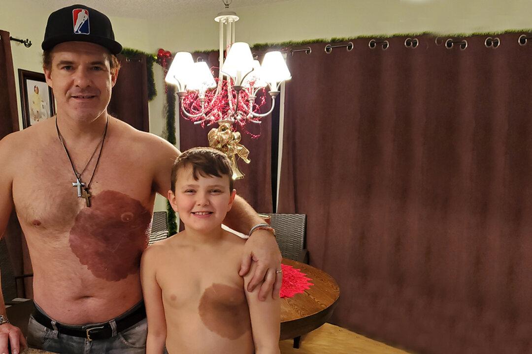 Dad Endures 30-Hour Tattoo, Surprises Son With Replica Birthmark to Boost His Confidence