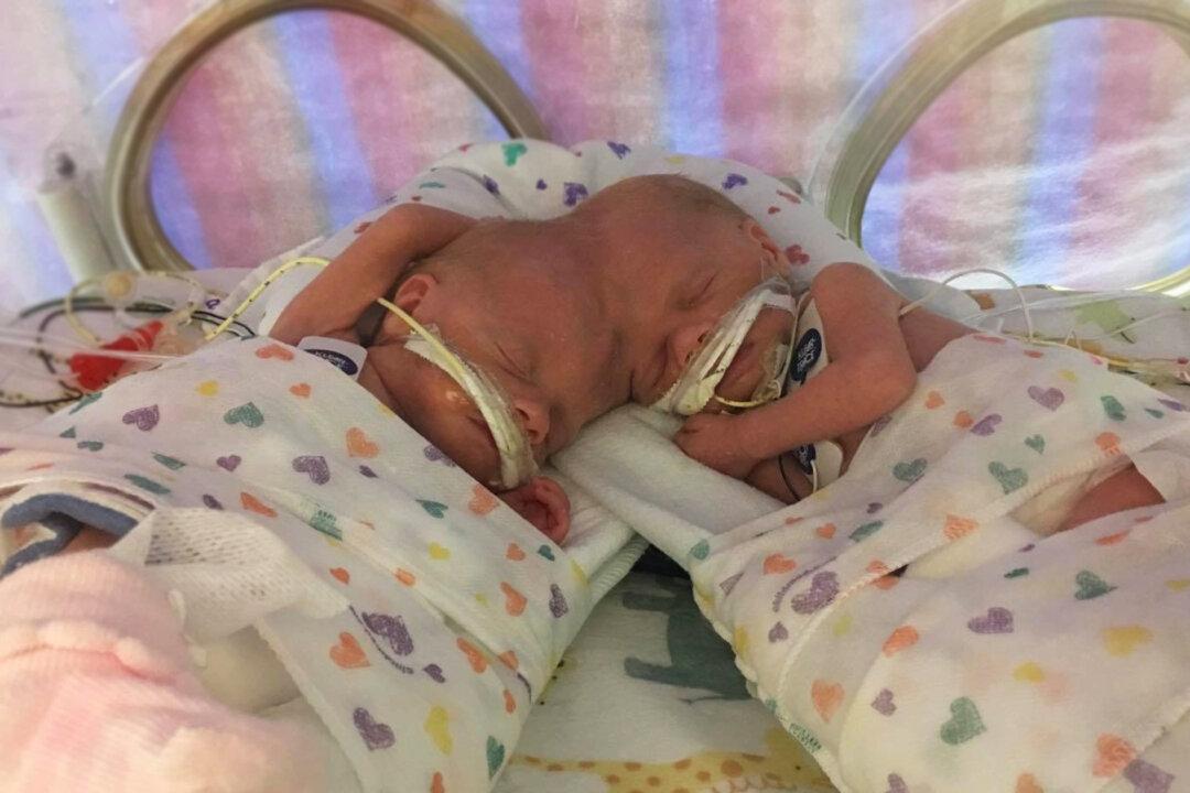 Twins Conjoined at Head Survived Separation, Are Now 4, Thriving, Prepping for Skull Reconstruction