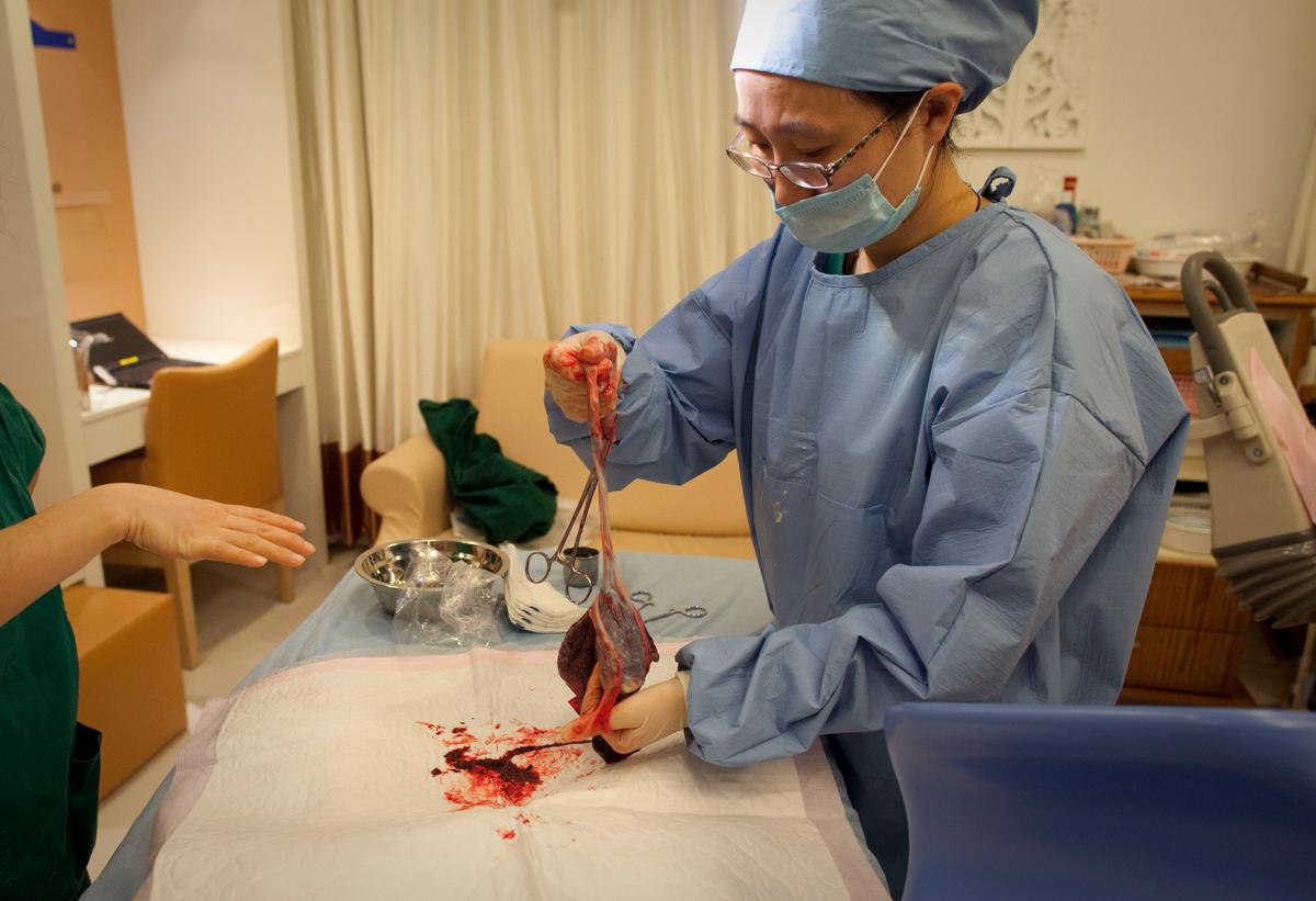 Dealers Purchase Placentas From Chinese Funeral Homes