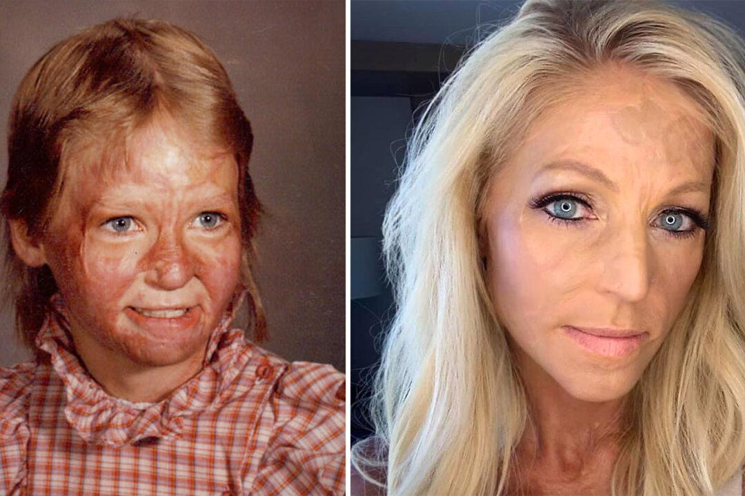 Woman Suffered Burns to 70 Percent of Her Body at Age 10, Walks Stage in Beauty Pageant to Fulfill Dream