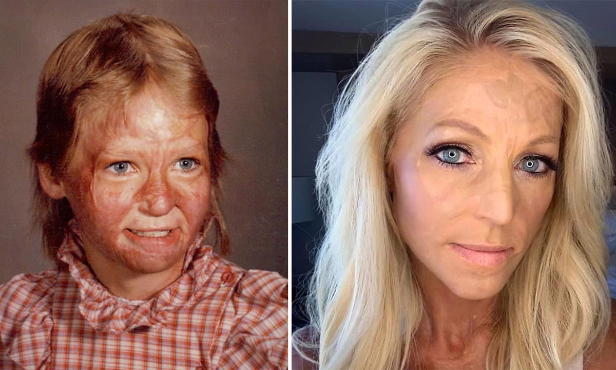 Woman Suffered Burns to 70 Percent of Her Body at Age 10, Walks Stage in Beauty Pageant to Fulfill Dream