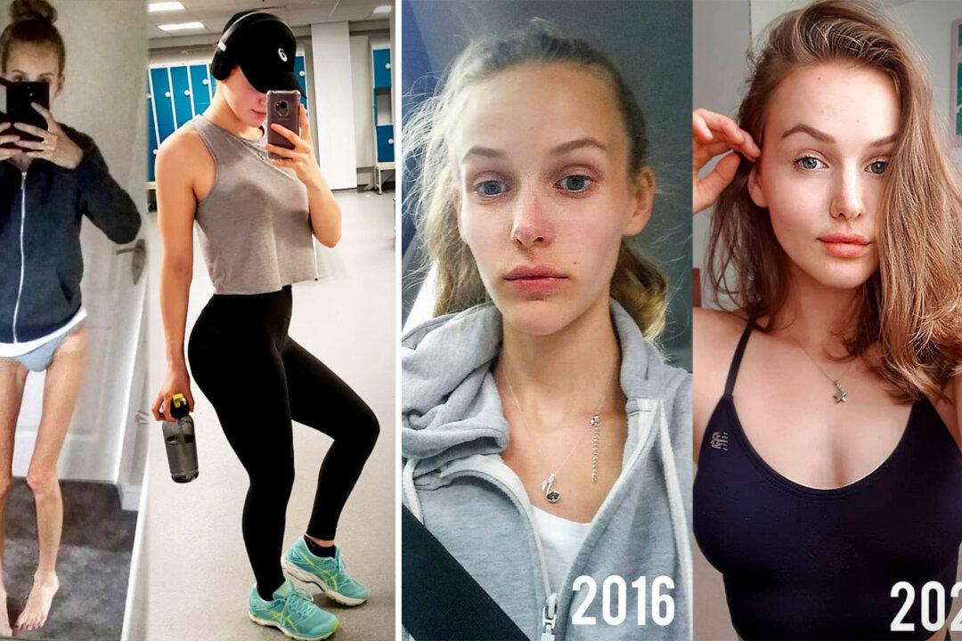 Anorexic Teen Was Rushed to Emergency–Became Fitness Guru After Making Incredible Recovery