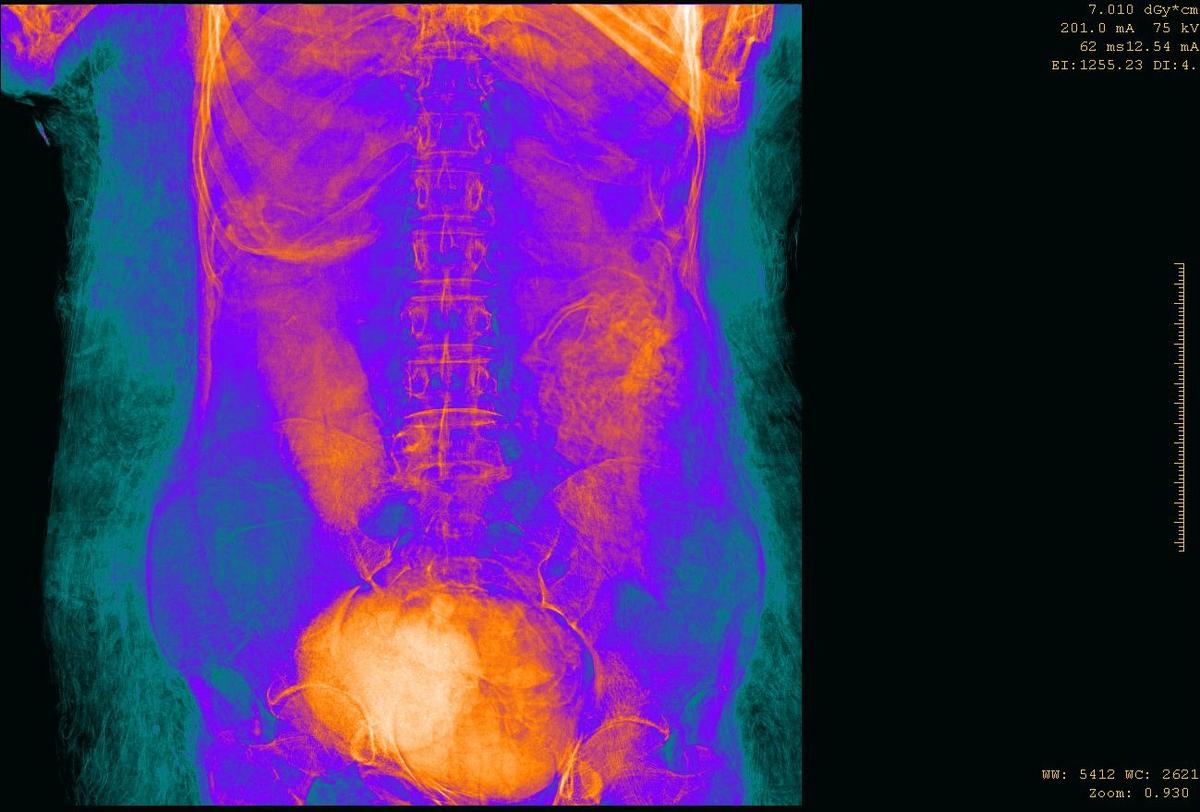 A CT scan shows the mummy's abdominal area. (Courtesy of Marzena Ożarek-Szilke/<a href="http://warsawmummyproject.com/en">Warsaw Mummy Project</a>)