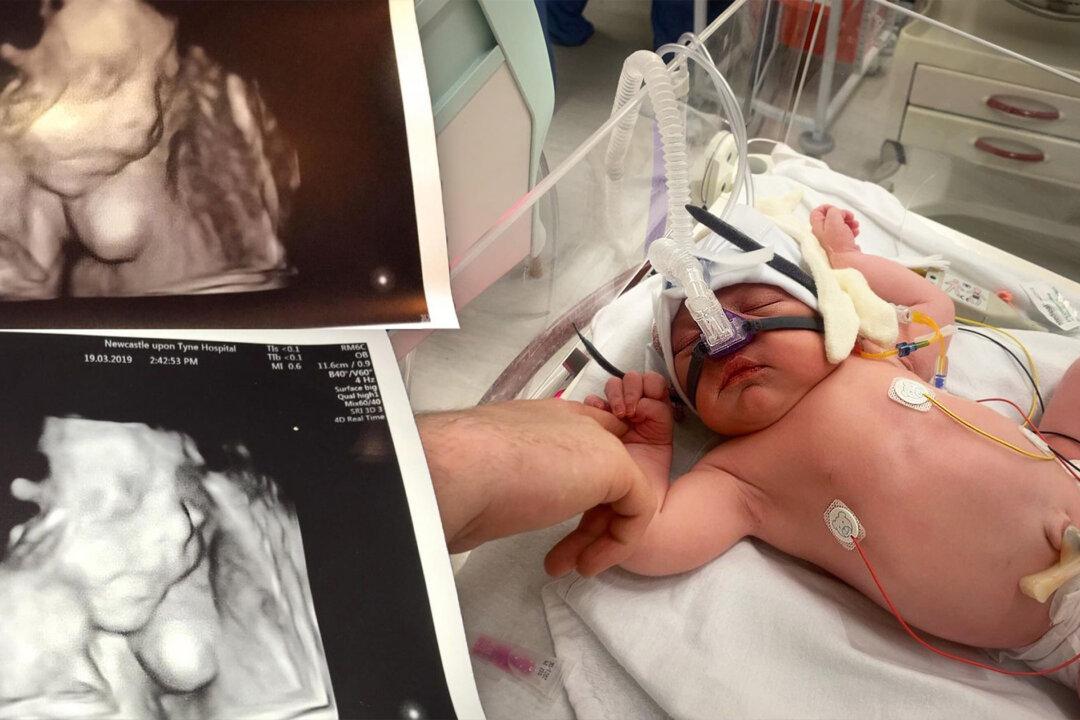 22-Month-Old’s Lungs Collapsed After He Was Born With Cysts—but Thanks to Health Workers, He’s Thriving