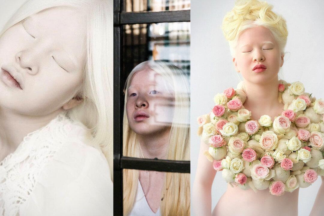 Albino Girl Abandoned by Parents in China Gets a New Life, Finds Success as a Teen Model