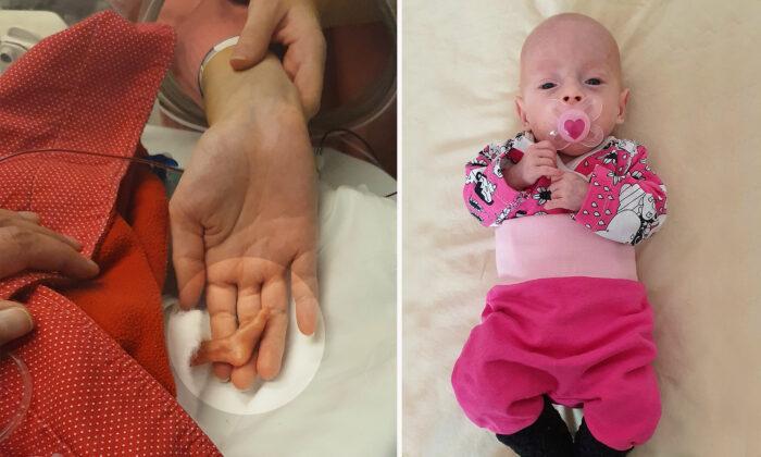 Over 1lb Preemie With Feet Half the Size of Her Mom’s Forefinger Defies Survival Odds