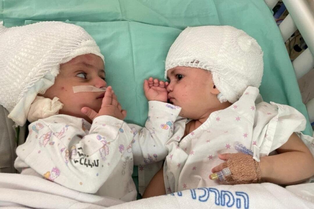 1-Year-Old Conjoined Twins Separated in Israel