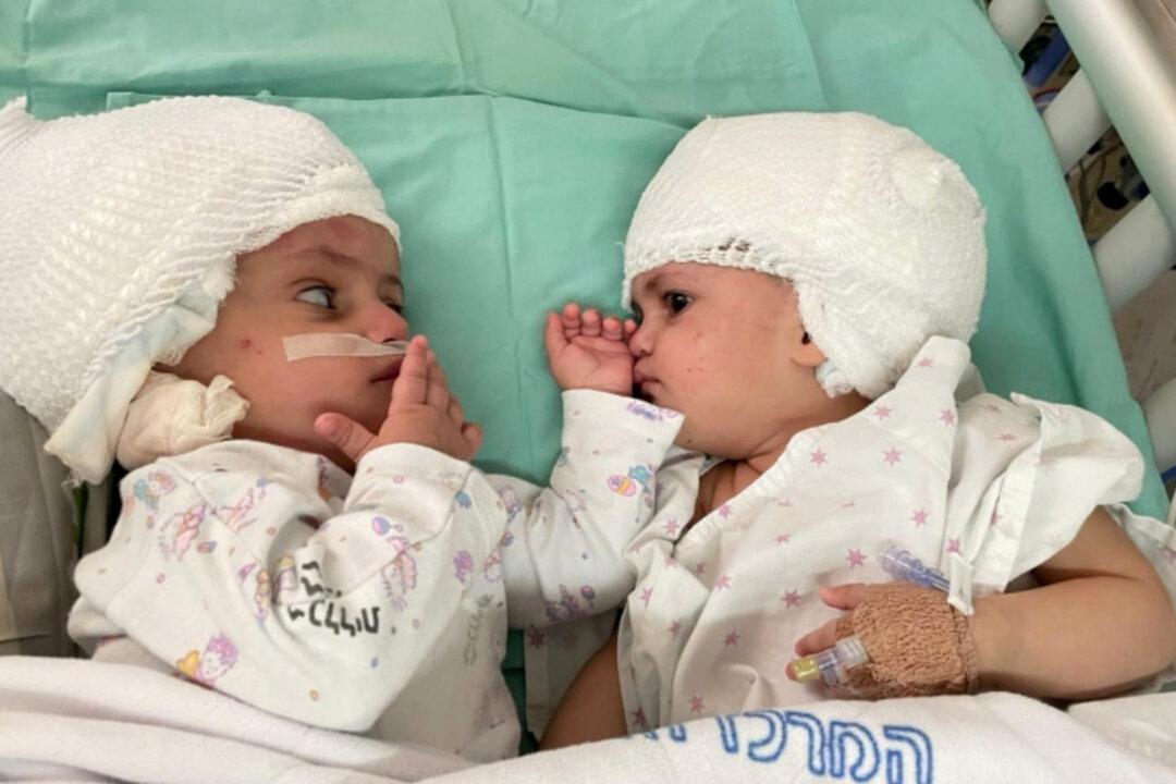 Twins Who Were Conjoined at the Head Are Successfully Separated After a 12-Hour Surgery