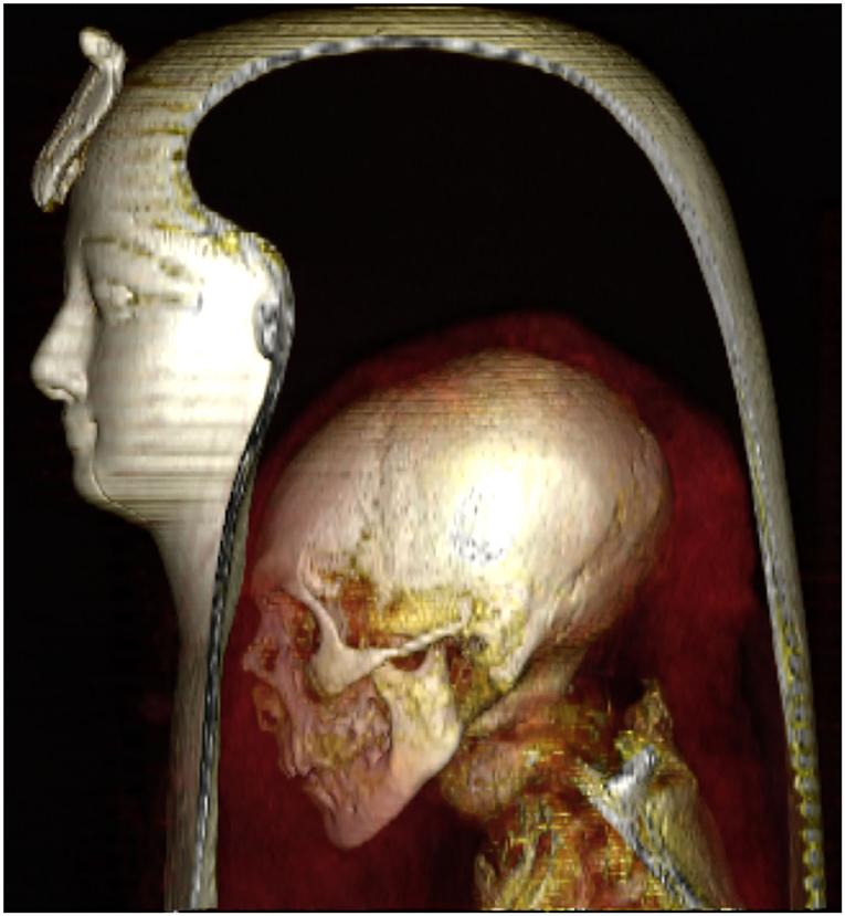 Three-dimensional CT image of the head of the wrapped mummy of Amenhotep I. (Courtesy of Sahar N. Saleem & Zahi Hawass)