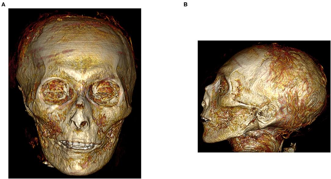 Three-dimensional CT image of the digitally unwrapped face of the mummy Amenhotep I. (Courtesy of Sahar N. Saleem & Zahi Hawass)