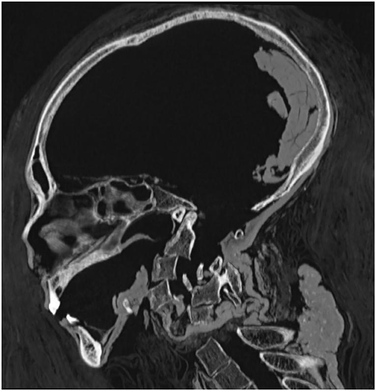 The preserved desiccated brain rests at the back of the skull. (Courtesy of Sahar N. Saleem & Zahi Hawass)