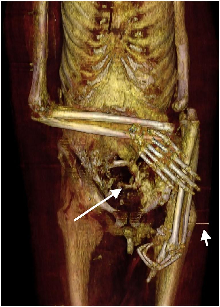 The right forearm is flexed at the elbow and crosses the lower abdomen transversely. The dislocated left arm and forearm are placed extended along the left side of the body. (Courtesy of Sahar N. Saleem & Zahi Hawass)