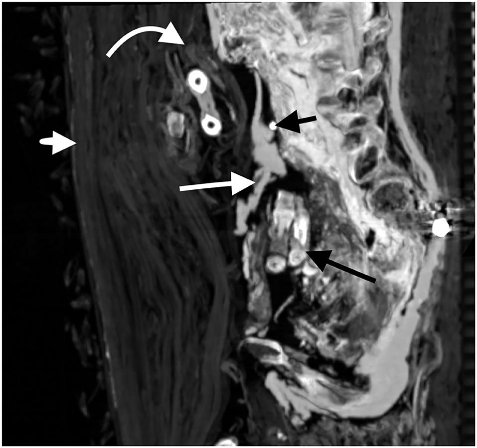 Two fingers missing from the left hand are placed inside the body cavity (indicated by the long black arrow). (Courtesy of Sahar N. Saleem & Zahi Hawass)