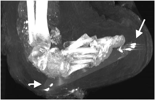 The right foot of the mummy of Amenhotep I with nails likely placed to fix the position of the wood plaque to the surrounding wrappings. (Courtesy of Sahar N. Saleem & Zahi Hawass)