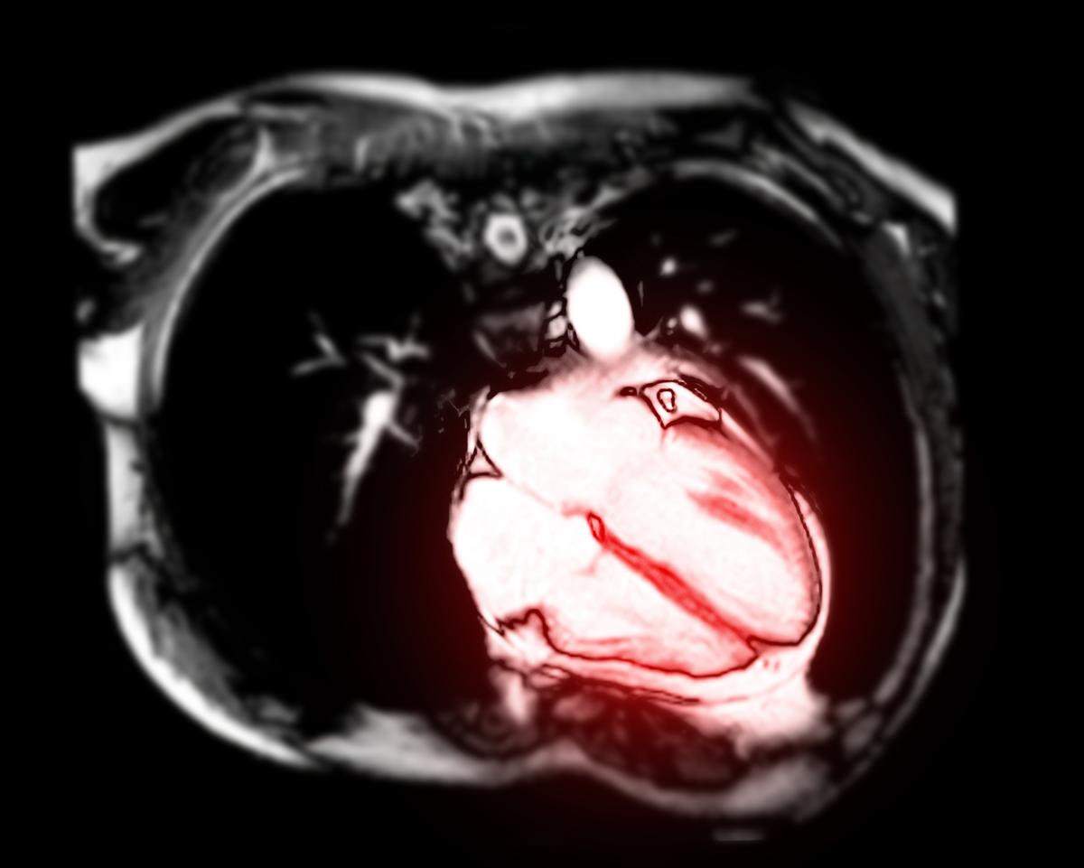 MRI Spots Heart Inflammation in Athletes Who Had COVID-19