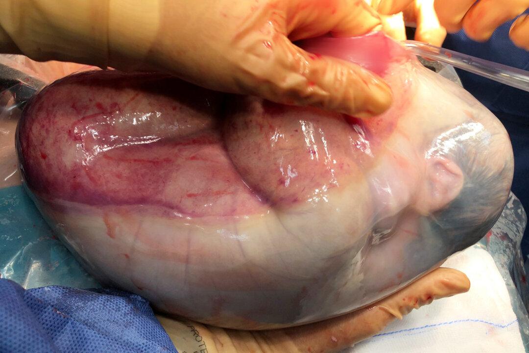 Magical Moment Shows Twin Girl Born Inside Amniotic Sac in 1-in-80,000 Rare Case