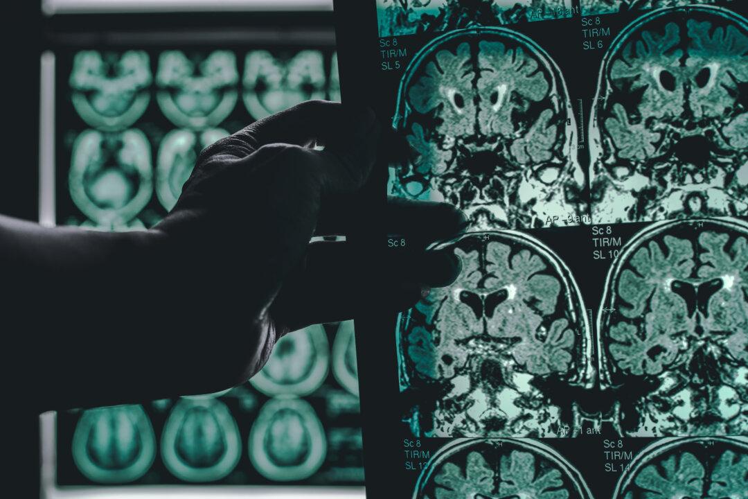 A Single Brain Scan Could Diagnose Alzheimer’s Disease