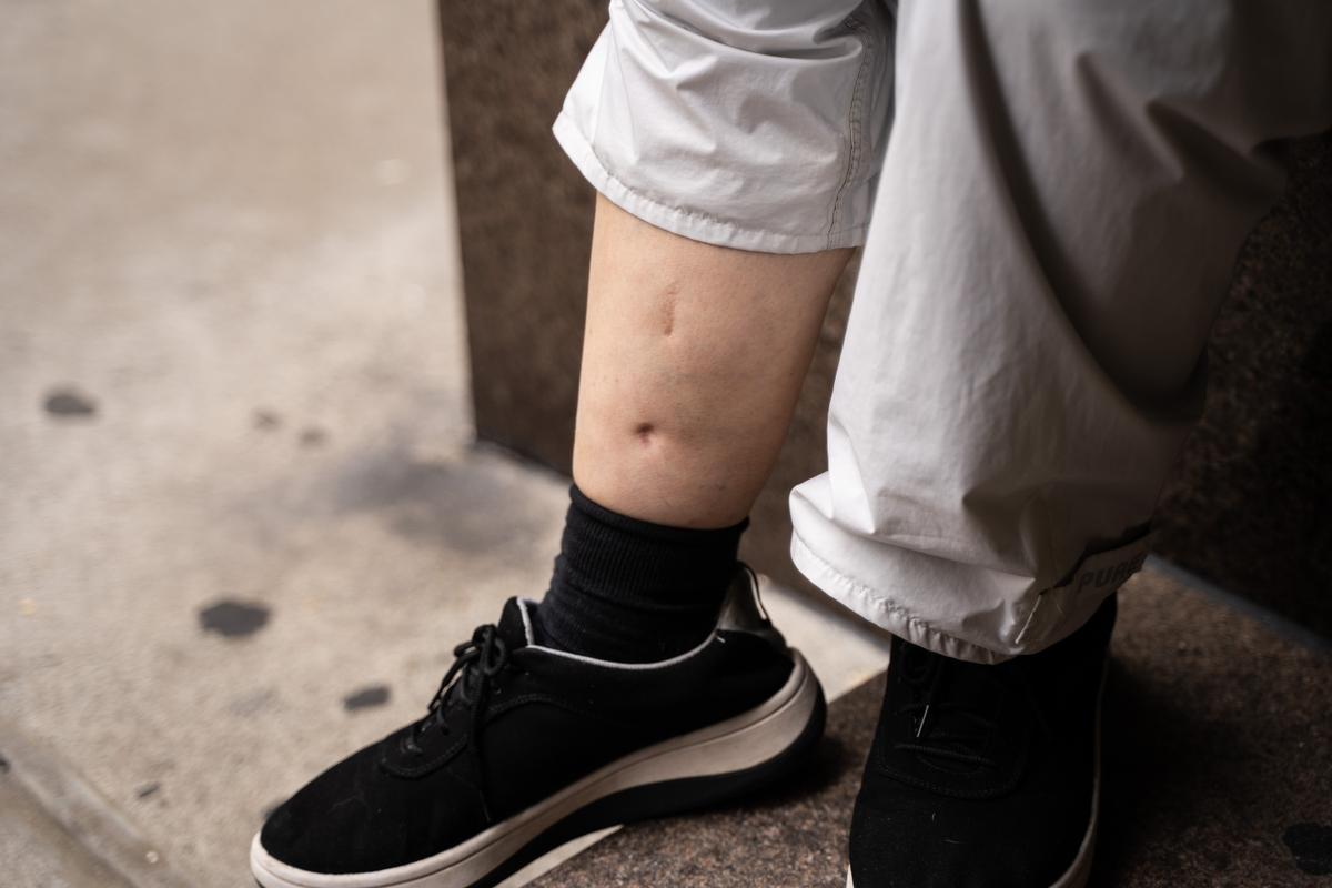 Liu Yan shows scars from surgery after a beating while in detention in China over two decades ago that caused her legs to swell up. Photo taken in Manhattan, New York, on May 13, 2022. (Samira Bouaou/The Epoch Times)