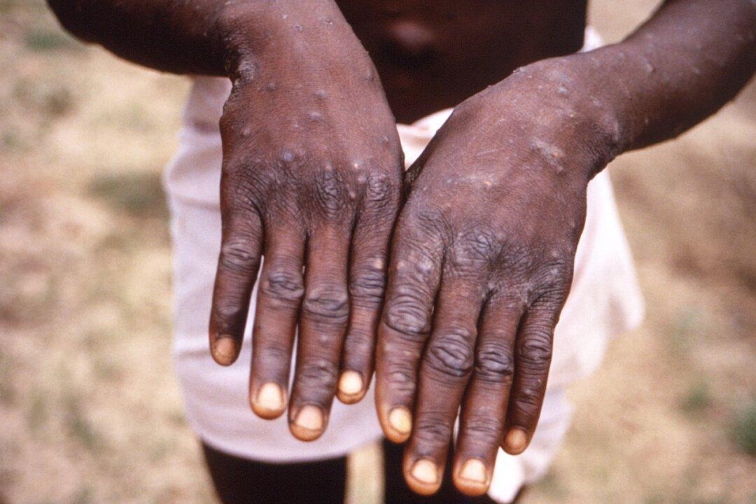 India Reports First Case of Monkeypox