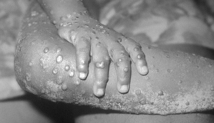 Canada’s First 2 Cases of Monkeypox Confirmed in Quebec as More Cases Reported Worldwide