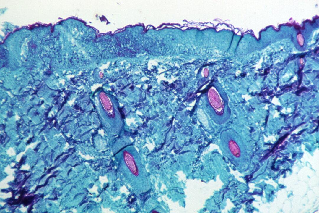 WHO Says Monkeypox May Have Been Spreading Undetected