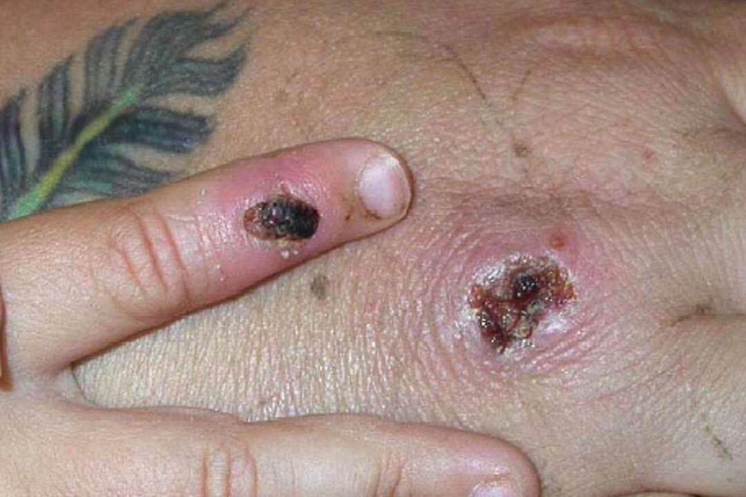 Scotland Records 1st Monkeypox Case as Self-Isolation Encouraged