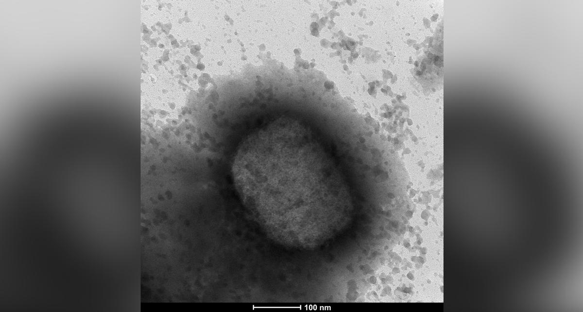 South Korea Confirms First Monkeypox Case, Infections Numbers From Around The World