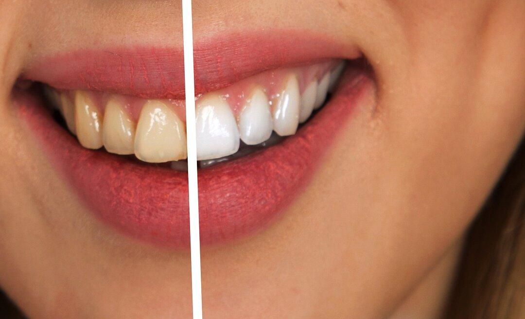 Ask a Dentist: Tooth Whitening