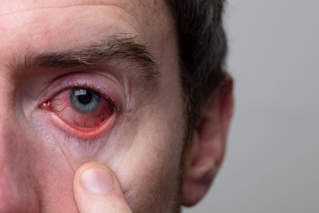 One in Three People Has This Eye Parasite