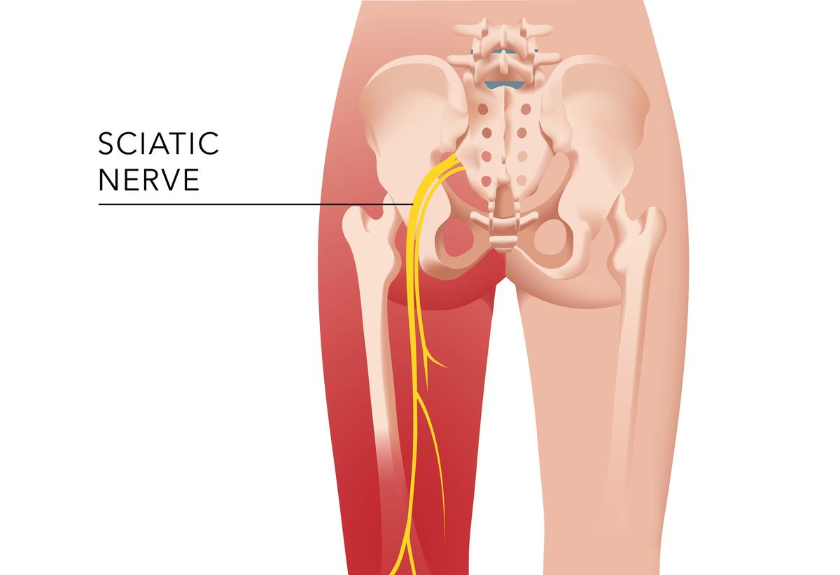 How I Healed My Sciatica