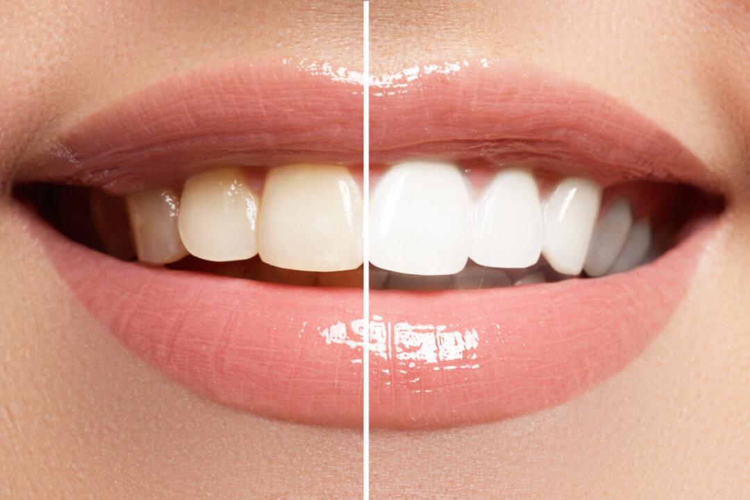 Tooth Whitening – Don’t Gamble With Your Teeth