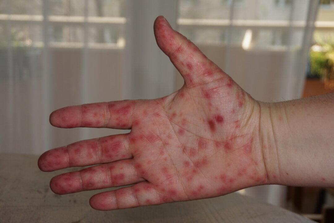 ‘Tomato Flu’ Outbreak in India – Here’s What It Really Is