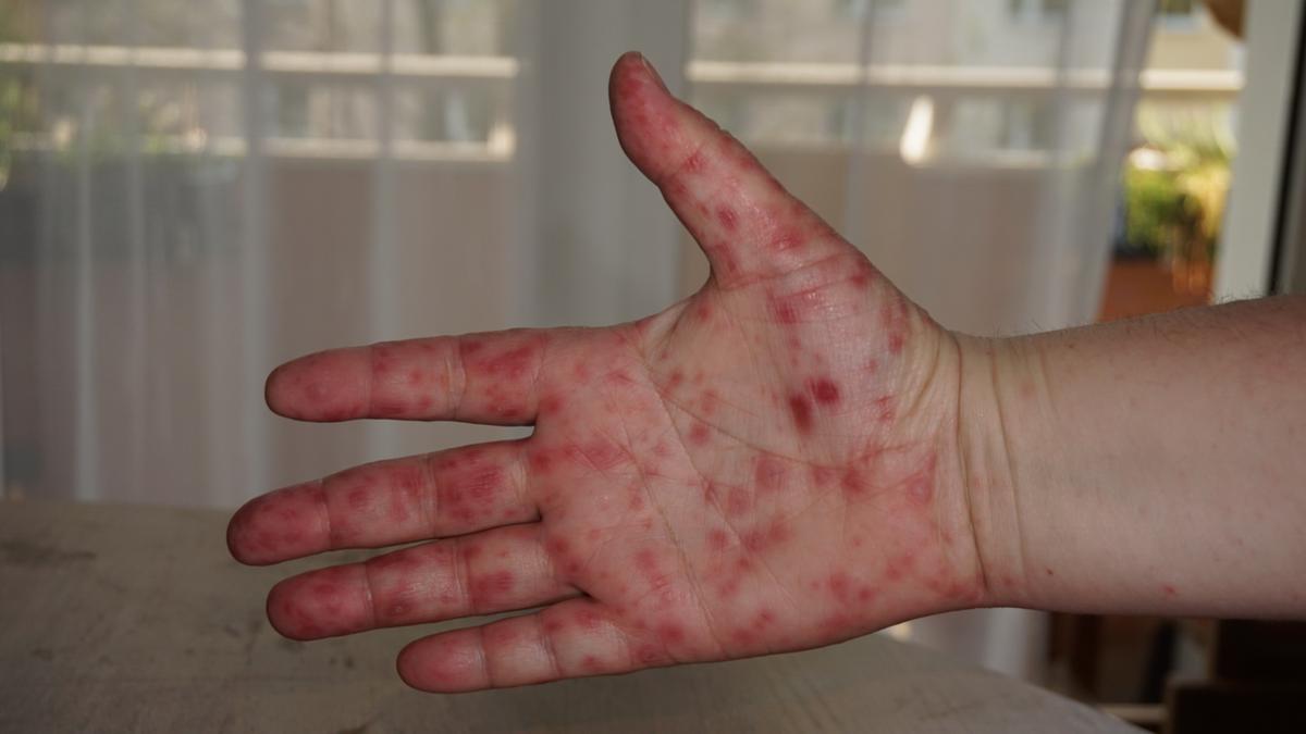 ‘Tomato Flu’ Outbreak in India – Here’s What It Really Is